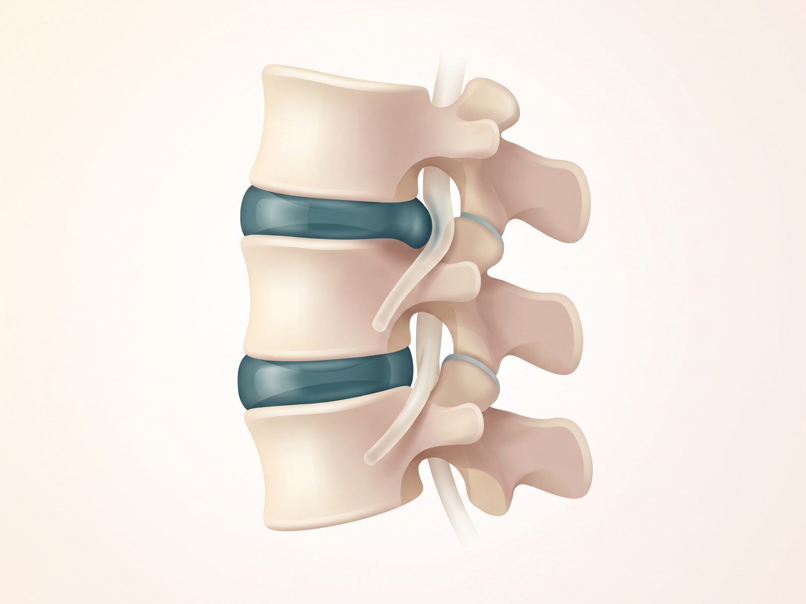 Illustrated cross-section of vertebrae showing a disc bulging toward the nerve space